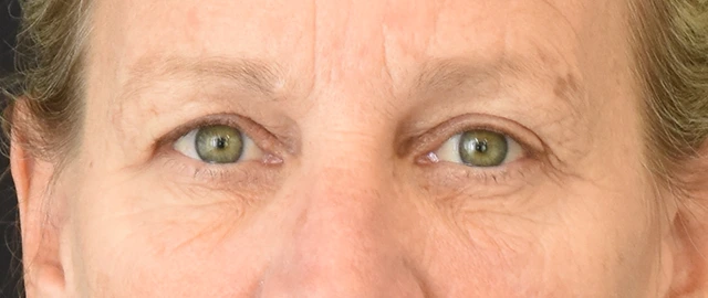 Brow Lift Patient 15 Set 1 Before