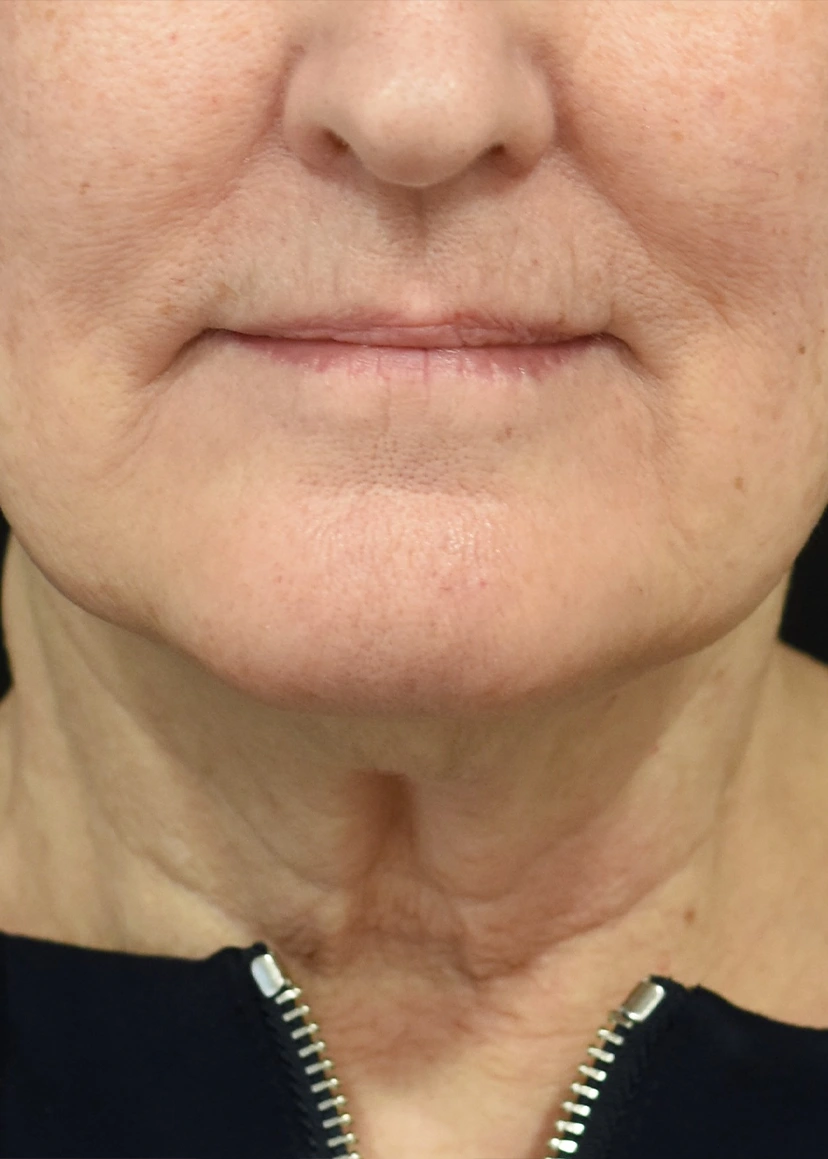 Deep Plane Facelift Patient 36 Set 1 Before