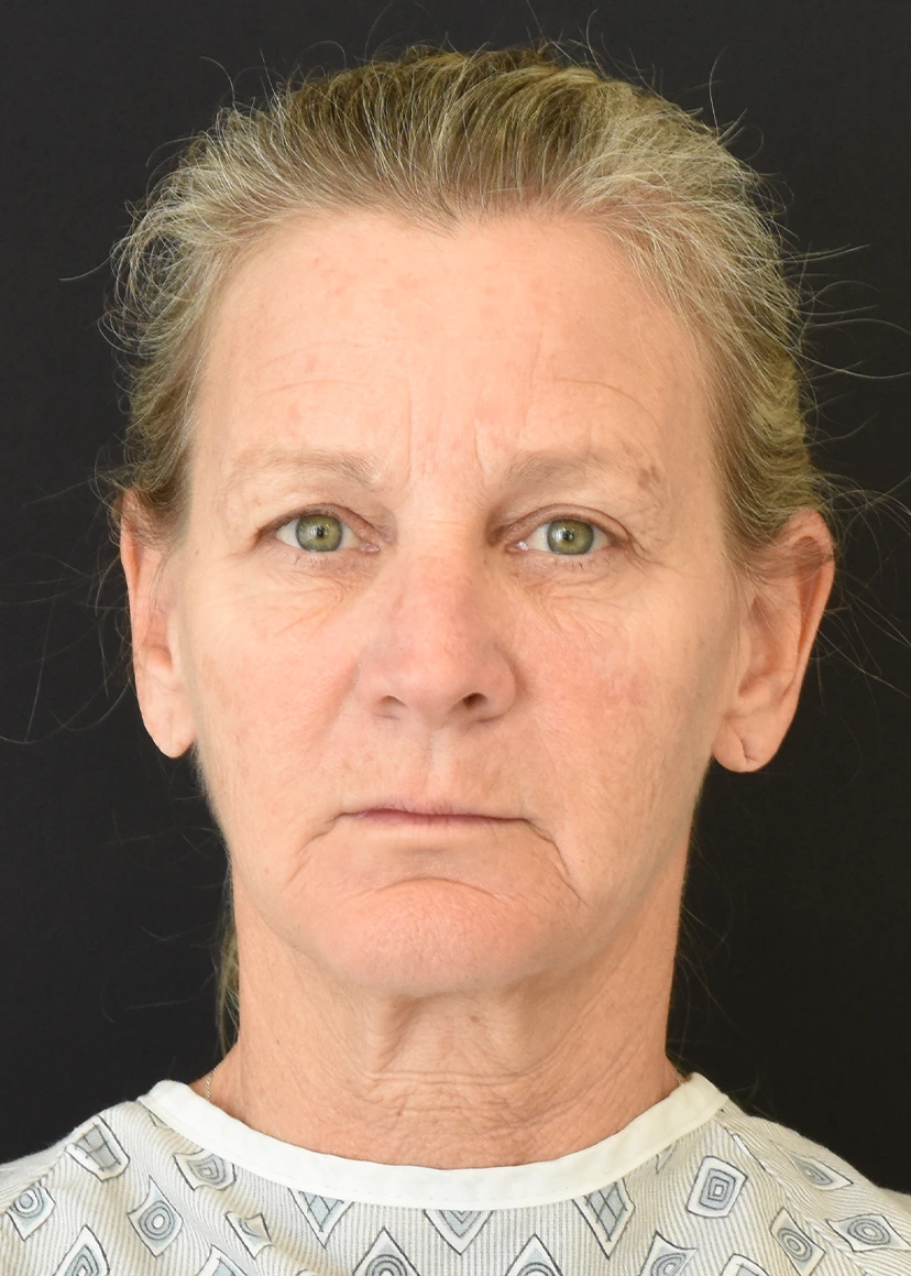 Deep Plane Facelift Patient 34 Set 3 Before