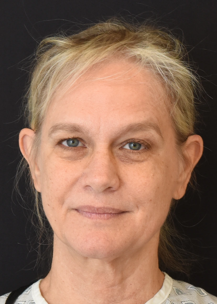 Deep Plane Facelift Patient 32 Set 1 Before