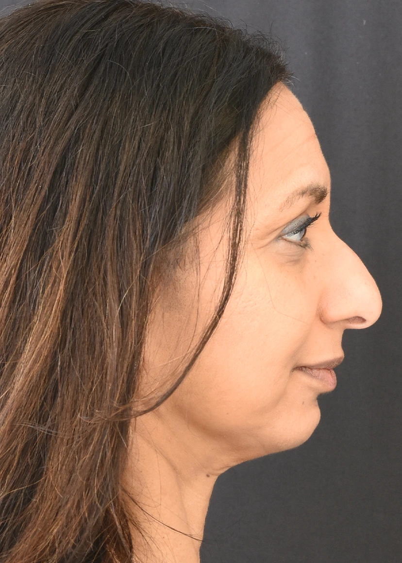 Rhinoplasty Patient 10 Set 3 Before