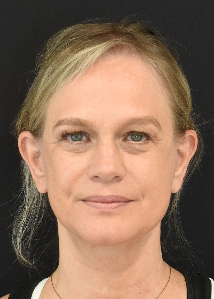 Deep Plane Facelift Patient 32 Set 1 After